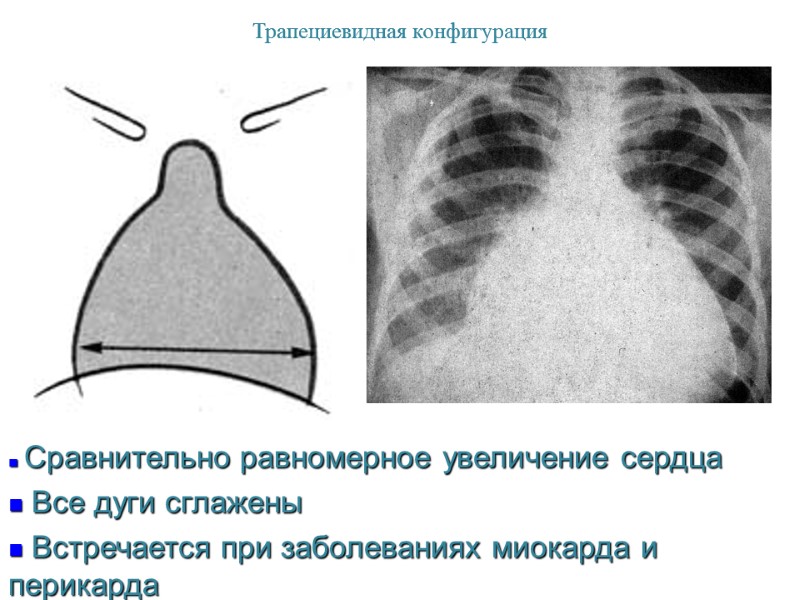 Трапециевидная конфигурация  Сравнительно равномерное увеличение сердца   Все дуги сглажены  